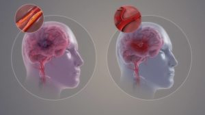الفرق بين الجلطة الدماغية والجلطة القلبية 